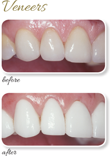 Veneers Case