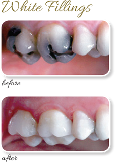 White Fillings Case