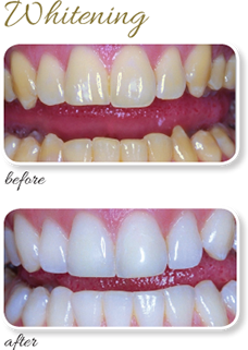 Whitening Case